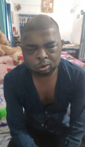 UP: Another engineer dies after hair transplant in Kanpur, probe ordered